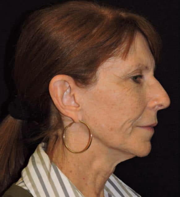 Facial Fat Grafting before and after, case 1979 - Cool Springs Plastic Surgery