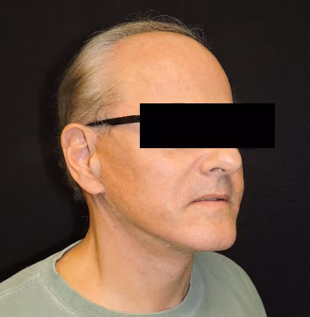 Facial Fat Grafting before and after, case 2072 - Cool Springs Plastic Surgery