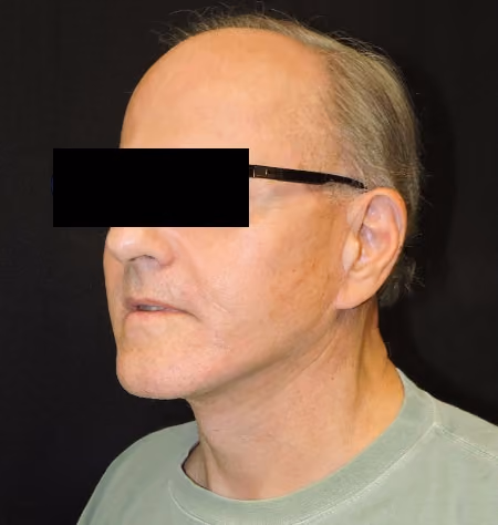 Facial Fat Grafting before and after, case 2072 - Cool Springs Plastic Surgery