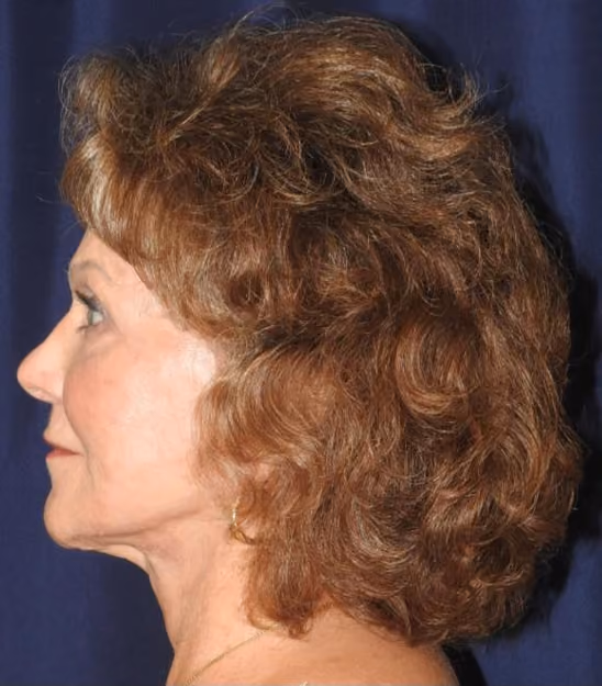 Facial Fat Grafting before and after, case 2632 - Cool Springs Plastic Surgery