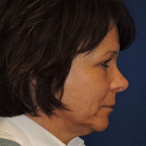 Eyelid Surgery before and after, case 2645 - Cool Springs Plastic Surgery