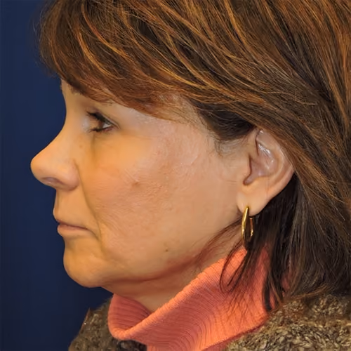 Eyelid Surgery before and after, case 2645 - Cool Springs Plastic Surgery