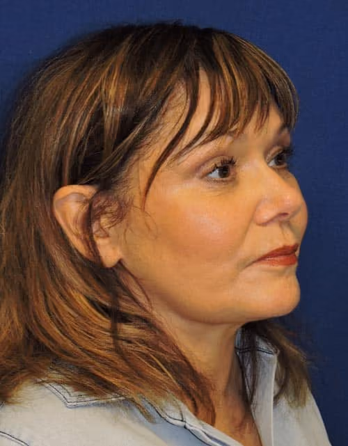 Facial Fat Grafting before and after, case 2832 - Cool Springs Plastic Surgery