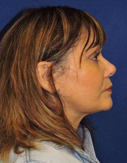 Facial Fat Grafting before and after, case 2832 - Cool Springs Plastic Surgery