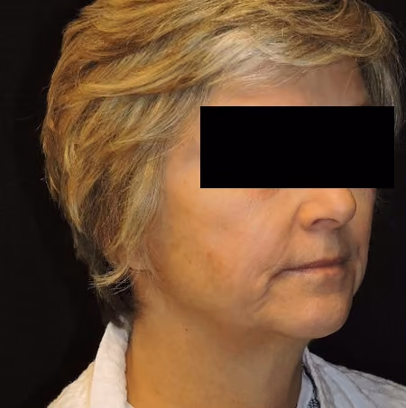 Facial Fat Grafting before and after, case 2857 - Cool Springs Plastic Surgery