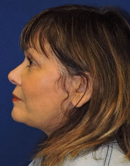 Facial Fat Grafting before and after, case 2832 - Cool Springs Plastic Surgery