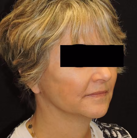 Facial Fat Grafting before and after, case 2857 - Cool Springs Plastic Surgery