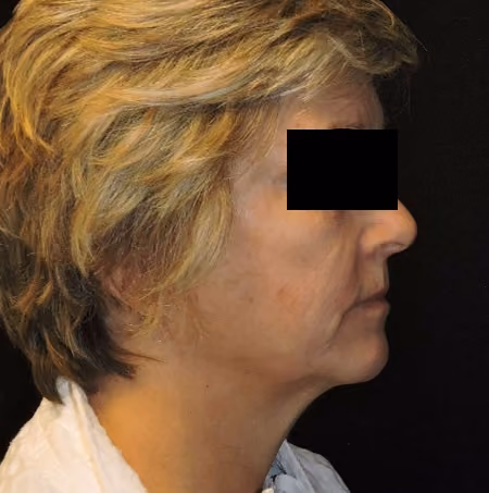 Facial Fat Grafting before and after, case 2857 - Cool Springs Plastic Surgery