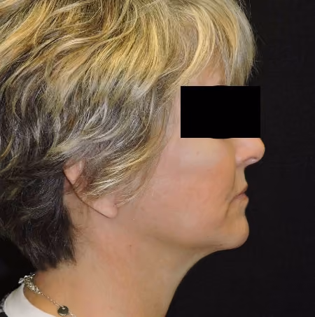 Facial Fat Grafting before and after, case 2857 - Cool Springs Plastic Surgery