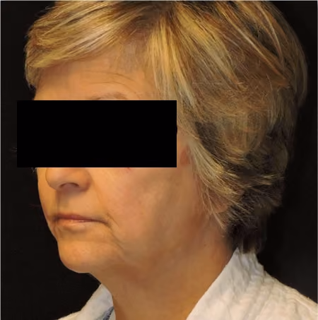 Facial Fat Grafting before and after, case 2857 - Cool Springs Plastic Surgery