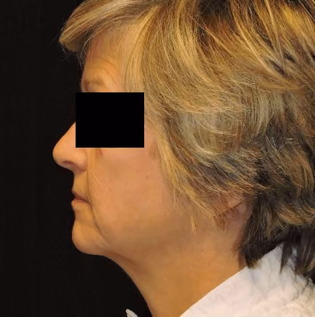 Facial Fat Grafting before and after, case 2857 - Cool Springs Plastic Surgery