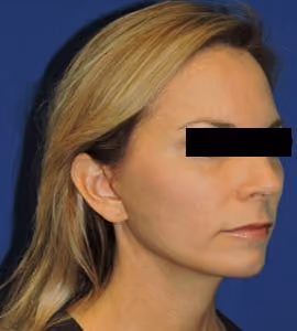 Facial Fat Grafting before and after, case 2935 - Cool Springs Plastic Surgery