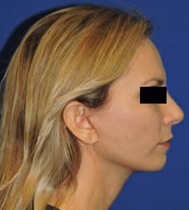 Facial Fat Grafting before and after, case 2935 - Cool Springs Plastic Surgery