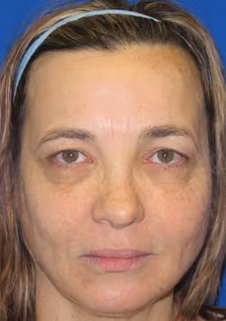 Eyelid Surgery before and after, case 2957 - Cool Springs Plastic Surgery