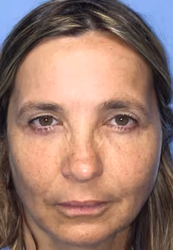 Eyelid Surgery before and after, case 2957 - Cool Springs Plastic Surgery