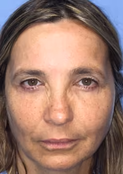 Eyelid Surgery before and after, case 2957 - Cool Springs Plastic Surgery