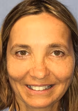 Eyelid Surgery before and after, case 2957 - Cool Springs Plastic Surgery