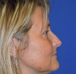 Eyelid Surgery before and after, Dr. Sarosiek, case 2972 - Cool Springs Plastic Surgery