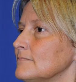 Eyelid Surgery before and after, Dr. Sarosiek, case 2972 - Cool Springs Plastic Surgery