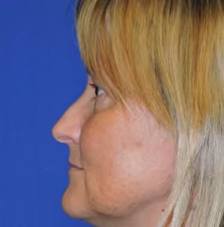 Eyelid Surgery before and after, Dr. Sarosiek, case 2972 - Cool Springs Plastic Surgery