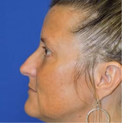Eyelid Surgery before and after, Dr. Sarosiek, case 2972 - Cool Springs Plastic Surgery