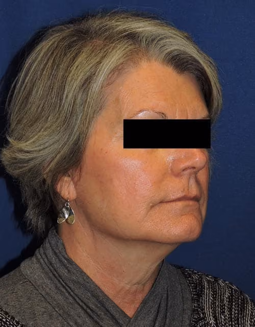 Facial Fat Grafting before and after, case 3014 - Cool Springs Plastic Surgery