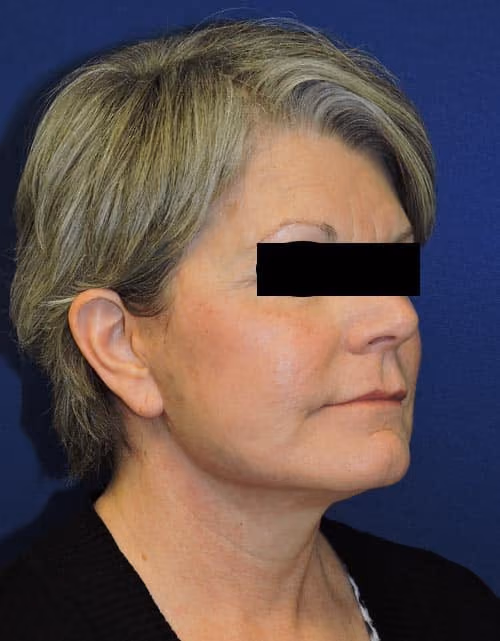 Facial Fat Grafting before and after, case 3014 - Cool Springs Plastic Surgery