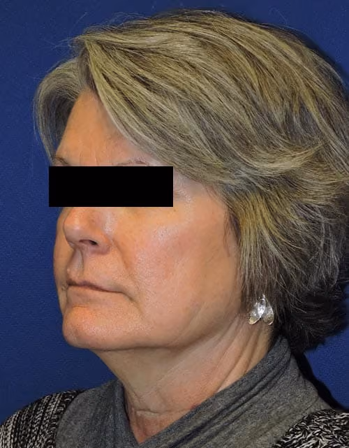 Facial Fat Grafting before and after, case 3014 - Cool Springs Plastic Surgery