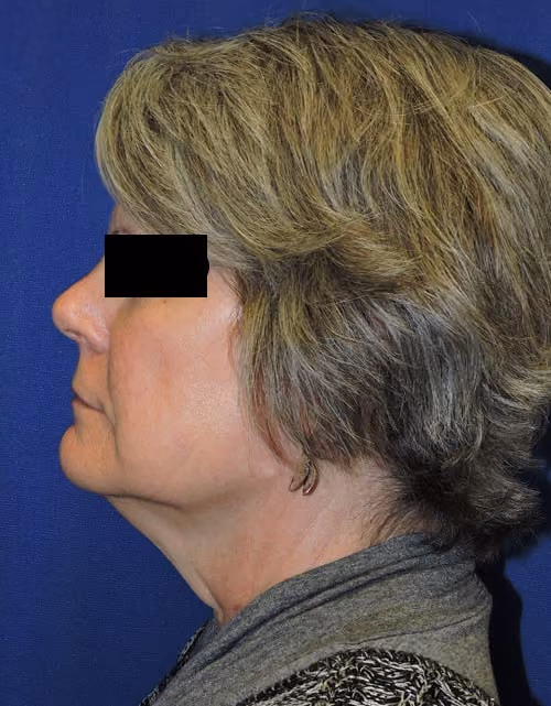 Facial Fat Grafting before and after, case 3014 - Cool Springs Plastic Surgery