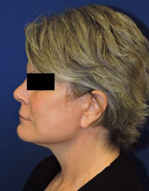 Facial Fat Grafting before and after, case 3014 - Cool Springs Plastic Surgery