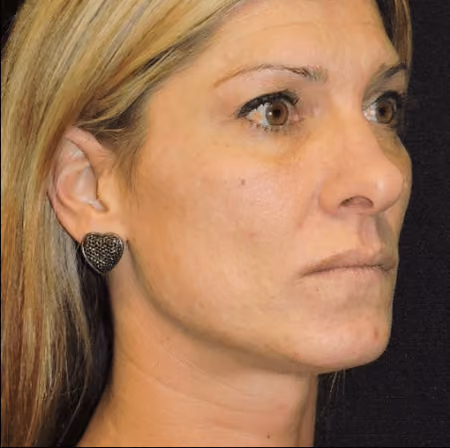Eyelid Surgery before and after, case 3048 - Cool Springs Plastic Surgery