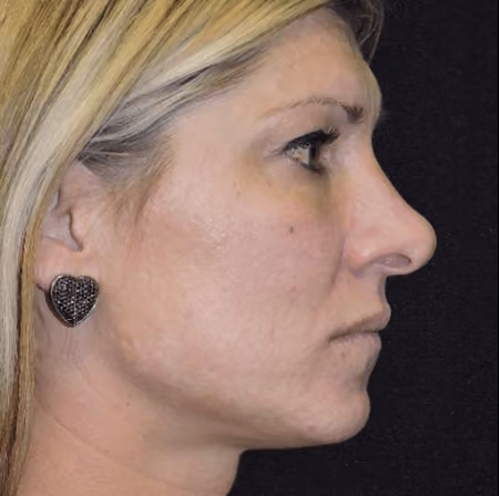Eyelid Surgery before and after, case 3048 - Cool Springs Plastic Surgery