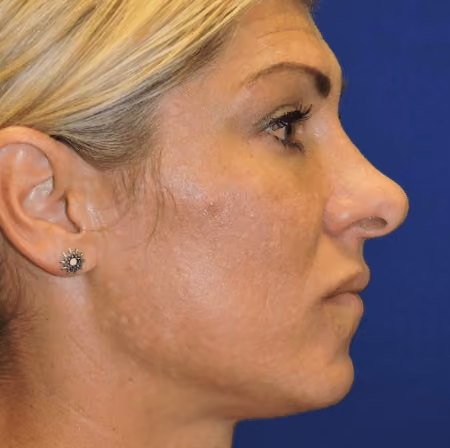 Eyelid Surgery before and after, case 3048 - Cool Springs Plastic Surgery
