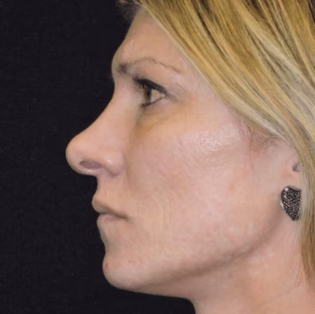 Eyelid Surgery before and after, case 3048 - Cool Springs Plastic Surgery