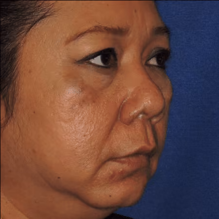 Eyelid Surgery before and after, case 3146 - Cool Springs Plastic Surgery