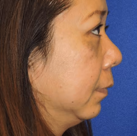 Eyelid Surgery before and after, case 3146 - Cool Springs Plastic Surgery