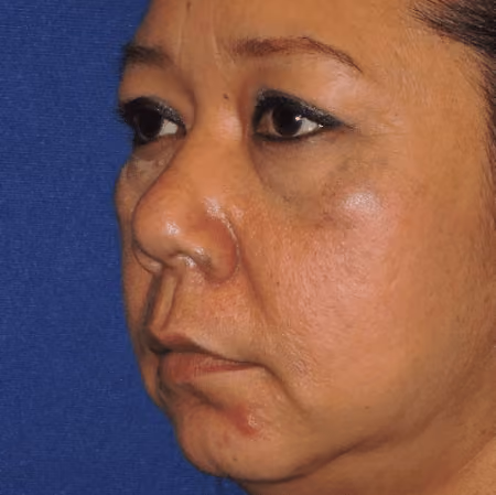 Eyelid Surgery before and after, case 3146 - Cool Springs Plastic Surgery