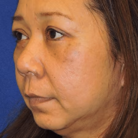 Eyelid Surgery before and after, case 3146 - Cool Springs Plastic Surgery