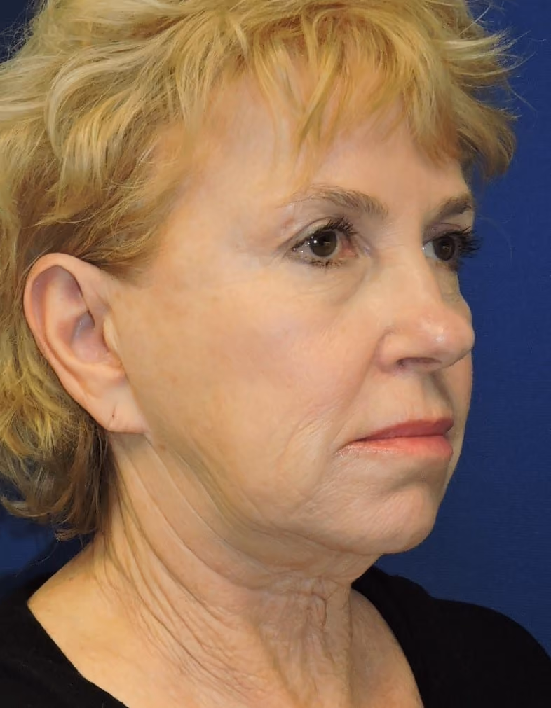 Facial Fat Grafting before and after, case 3172 - Cool Springs Plastic Surgery