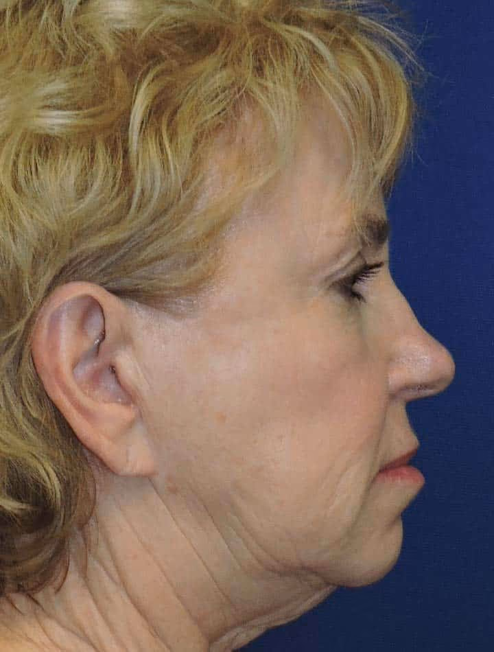 Facial Fat Grafting before and after, case 3172 - Cool Springs Plastic Surgery