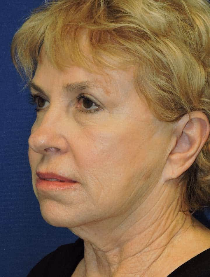 Facial Fat Grafting before and after, case 3172 - Cool Springs Plastic Surgery
