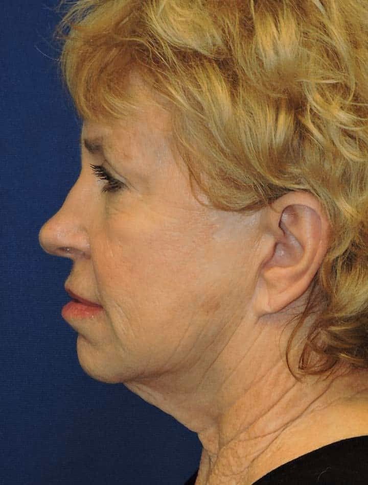 Facial Fat Grafting before and after, case 3172 - Cool Springs Plastic Surgery