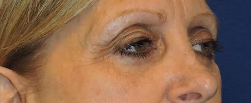 Eyelid Surgery before and after, case 3259 - Cool Springs Plastic Surgery