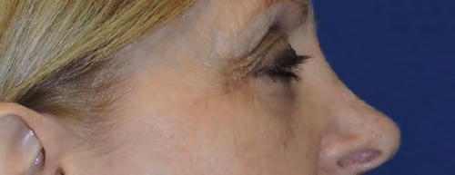 Eyelid Surgery before and after, case 3259 - Cool Springs Plastic Surgery
