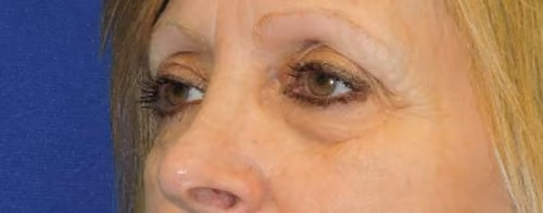 Eyelid Surgery before and after, case 3259 - Cool Springs Plastic Surgery