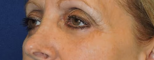 Eyelid Surgery before and after, case 3259 - Cool Springs Plastic Surgery