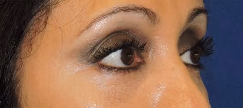 Eyelid Surgery before and after, case 3273 - Cool Springs Plastic Surgery