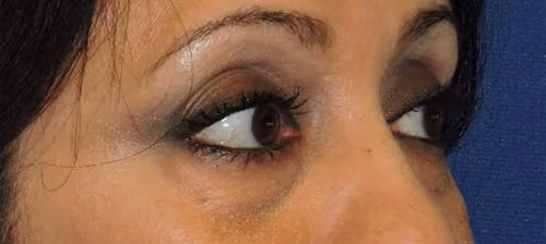 Eyelid Surgery before and after, case 3273 - Cool Springs Plastic Surgery