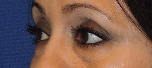 Eyelid Surgery before and after, case 3273 - Cool Springs Plastic Surgery