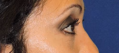 Eyelid Surgery before and after, case 3273 - Cool Springs Plastic Surgery